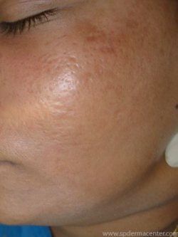 Acne Scar Co2 Fraxel After